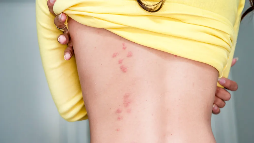 Bites from biting insects in Port Elizabeth